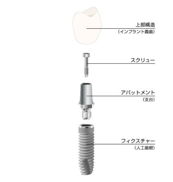 インプラント治療について