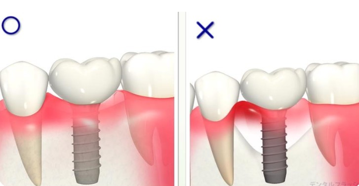インプラントが長持ちしないリスクについて〈インプラント周囲炎（インプラントの歯周病）〉