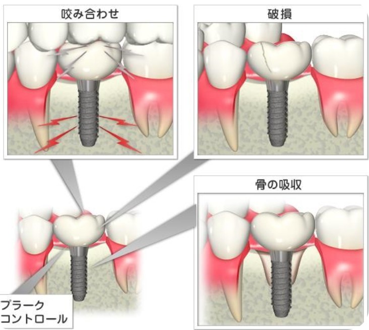 インプラントが長持ちしないリスクについて〈インプラントの破損・ゆるみ、被せものの破折〉